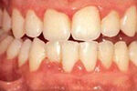 gingivitis-fin