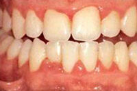 gingivitis-fin-2