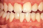 gingivitis-fin-2