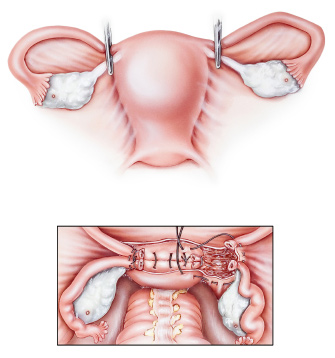 abdominalna histerektomija