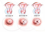 hpv4