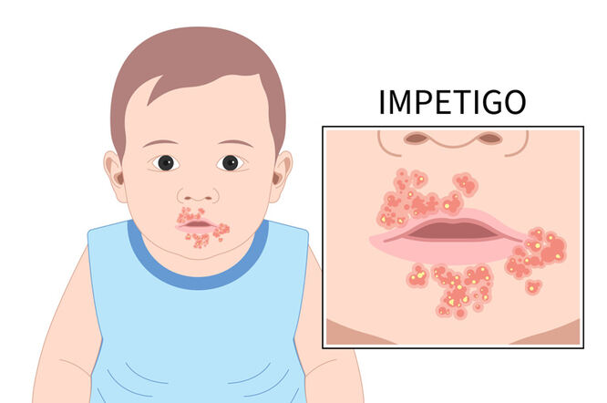 impetigo-1ndn