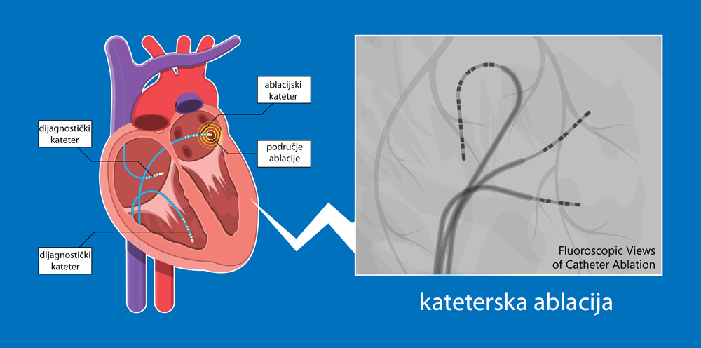kateterska-ablacija-3ndn