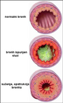 kopb-bronhi
