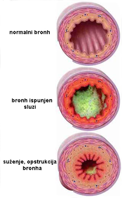 kopb-bronhi2