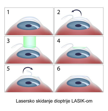 LASIK-1b