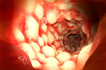 Morbus-Crohn-1b-