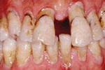 napredni-parodontitis-fin-2