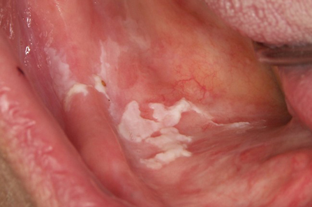 oralna-leukoplakija-1nd.