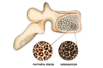 Qué significa la osteopenia