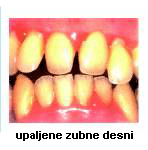 parodontne-bolesti-2