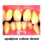 parodontne-bolesti-2
