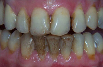 pigmentacije-na-zubima-1