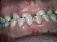 preosjetljivost zubi 6