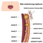 rak-mokracnog-mjehura-1b