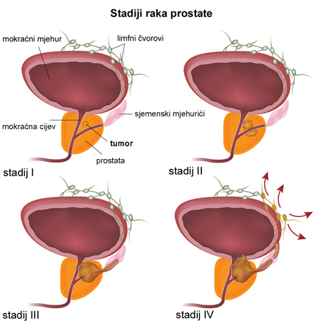 Dijagnosticiranje Raka Prostate Rak Prostate Centri A Z Cybermed Hr