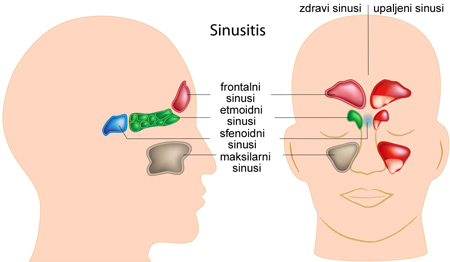 sinusitis-1b