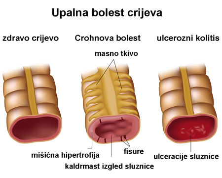 upalna-bolest-crijeva-1c