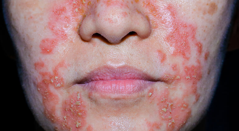 Koji su uzroci seboroičnog dermatitisa i kako se on liječi?
