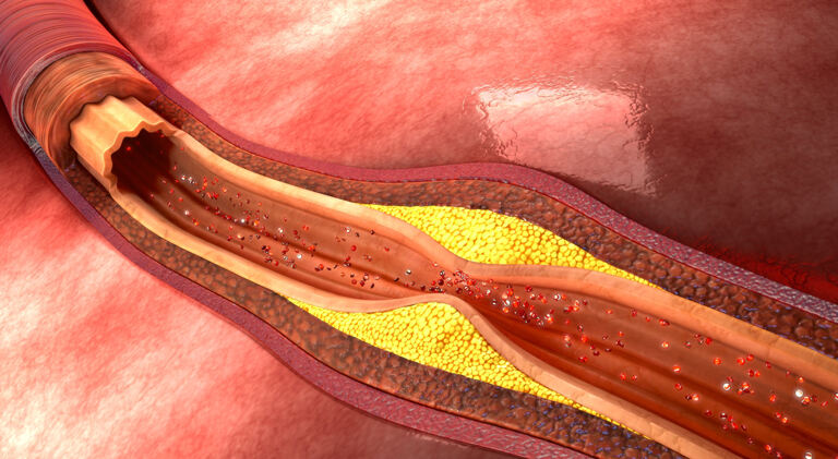Što je ateroskleroza?