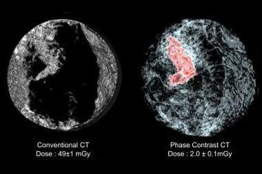 3D mamogrami poboljšavaju otkrivanje karcinoma dojke