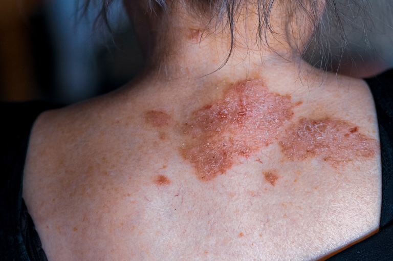 Abdominalna masnoća neovisni čimbenik rizika za psorijazu kod žena