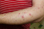 Abrocitinib učinkovit u liječenju pruritičkih dermatoza