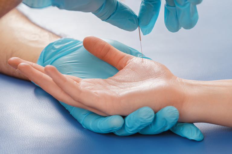 Akupunktura može pomoći pacijentima na intenzivnoj njezi da se brže oporave