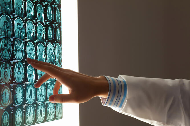 Alzheimerova bolest povezana s poremećajem oksigenacije mozga i funkcije neurona