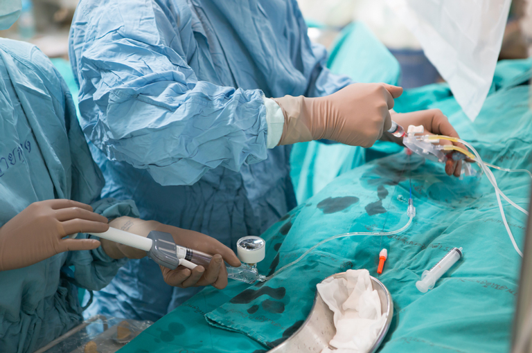 Angioplastika poboljšava simptome kod pacijenata s kroničnom potpunom koronarnom okluzijom