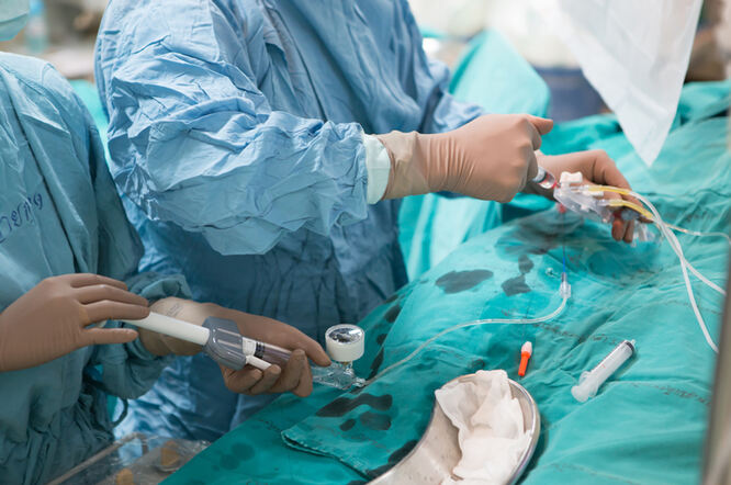 Angioplastika poboljšava simptome kod pacijenata s kroničnom potpunom koronarnom okluzijom