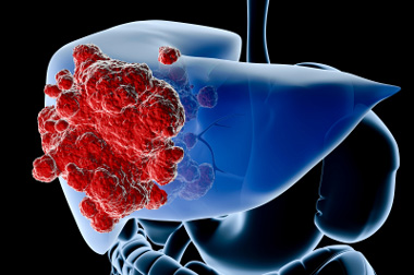 Antivirusna terapija za hepatitis C smanjuje rizik od raka jetre