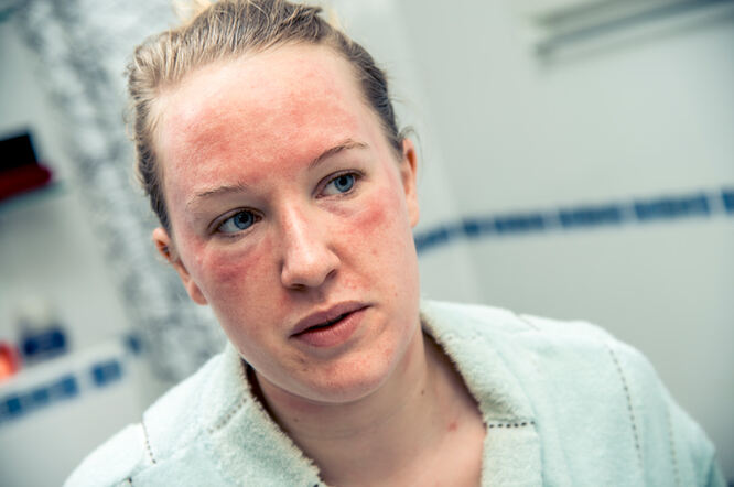 Atopijski dermatitis povećava rizik od periferne vaskularne bolesti