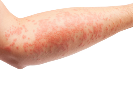 Atopijski dermatitis smanjuje rizik od razvoja raka kože