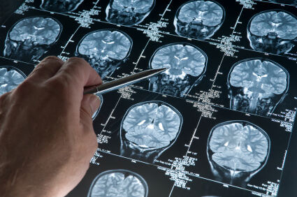 Atrofija određenog područja mozga može biti znak početka multiple skleroze