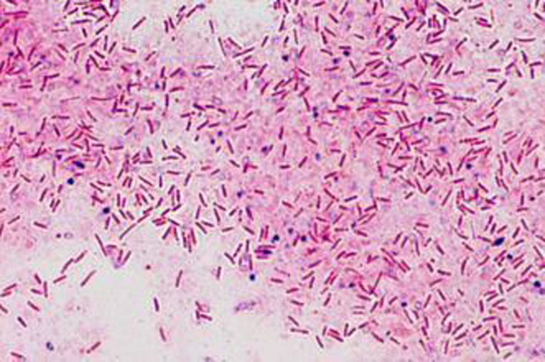 Bakterijska infekcija krvi povezana s povećanjem rizika od raka debelog crijeva