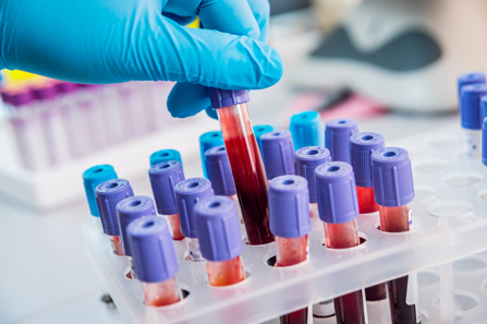 CEA krvni test poboljšava stratifikaciju raka debelog crijeva