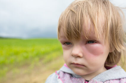 Druga teška alergijska reakcije kod djece nije neuobičajena