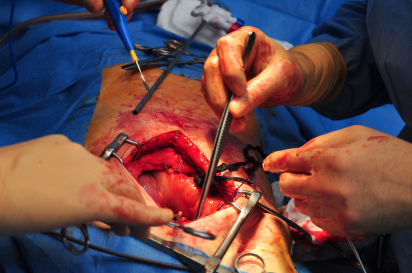 Duljina kirurškog zahvata povećava rizik od stvaranja krvnog ugruška