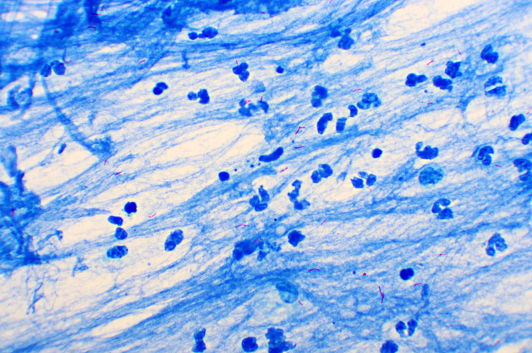 Globalni broj slučajeva tuberkuloze dosegnuo rekordnu razinu