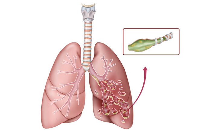 Gnojenje sputuma može predvidjeti ishode kod bronhiektazija