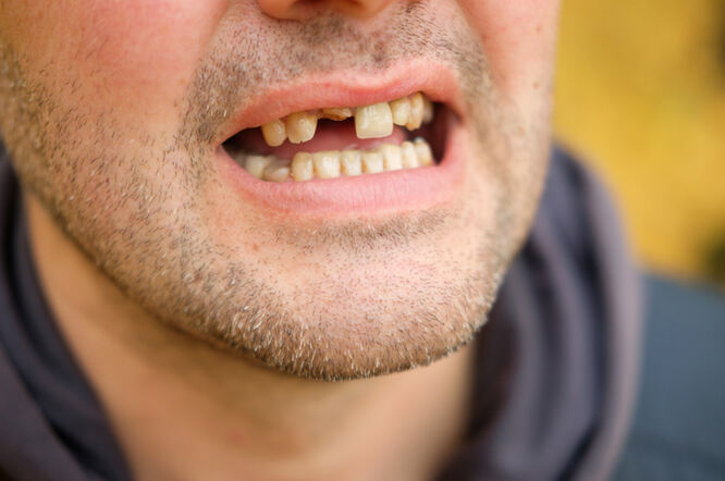 Gubitak zuba može povećati rizik od kognitivnog propadanja i demencije