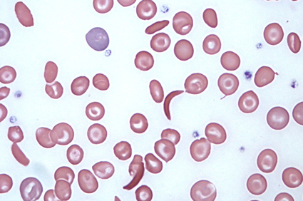Hidroksiureja uspješna u liječenju anemije srpastih stanica u djece