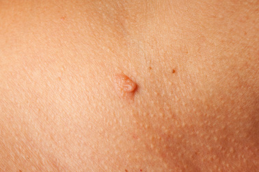 HPV može povećati rizik za razvoj planocelularnog raka kože 