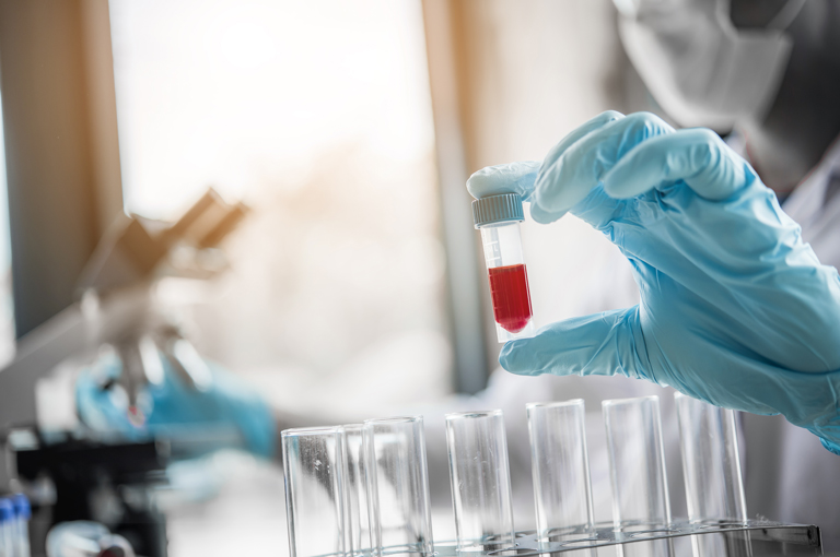 Je li Alzheimerova bolest češća nego što se prije mislilo?