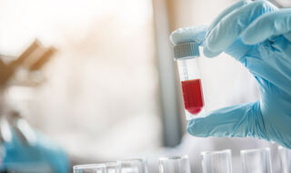 Je li Alzheimerova bolest češća nego što se prije mislilo?