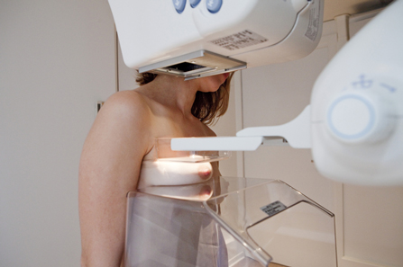 Je li gustoća tkiva dojke najvažniji čimbenik rizika za rak dojke?