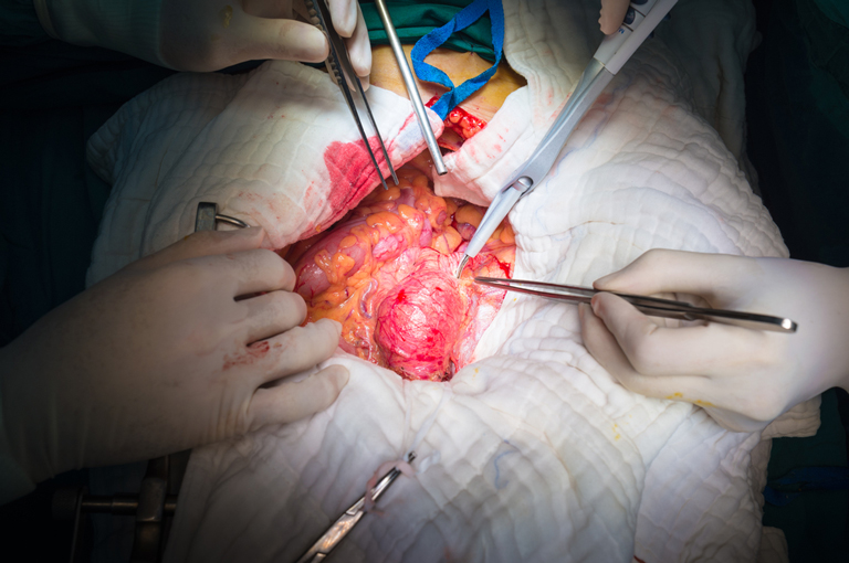 Kako smanjiti rizik od rupture aneurizme aorte?