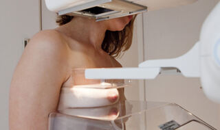 Kalcifikacija arterija dojke na mamografima predviđa budući rizik od srčanih oboljenja