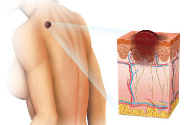 Kombinacija dvaju lijekova može odgoditi napredovanje melanoma